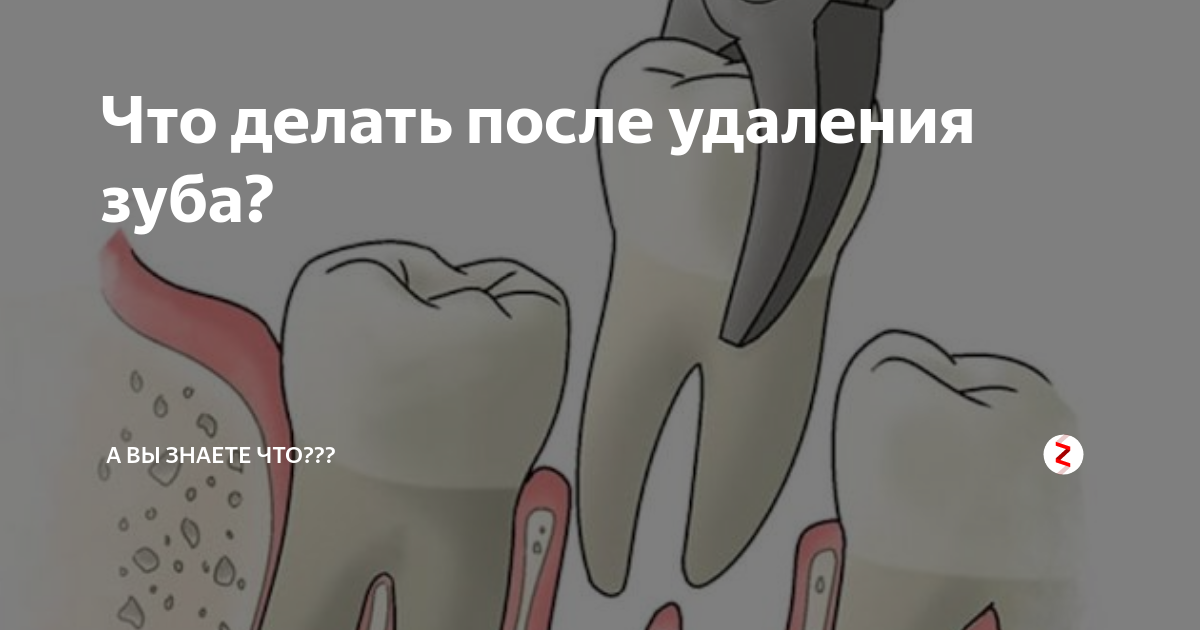 Рекомендации после удаления зуба. После удаления зуба мудрости рекомендации. Что делать после удаления зуба. Что нельзя после удаления зуба. После того как удалили зуб что нельзя делать