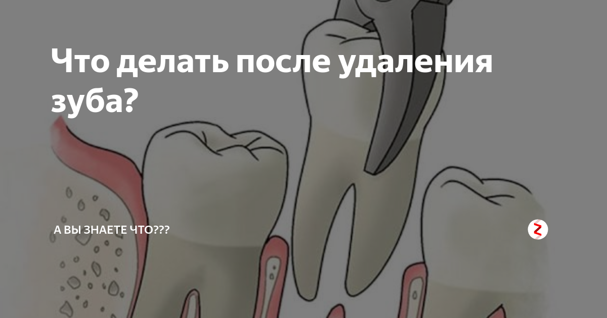 Что делать после 4. После удаления зуба мудрости рекомендации. Что делать после удаления зуба. Что нельзя после удаления зуба. После того как удалили зуб что нельзя делать.