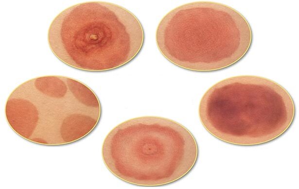 Изображение: Bay Area Lyme Foundation