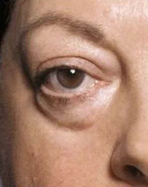 Мешки под глазами