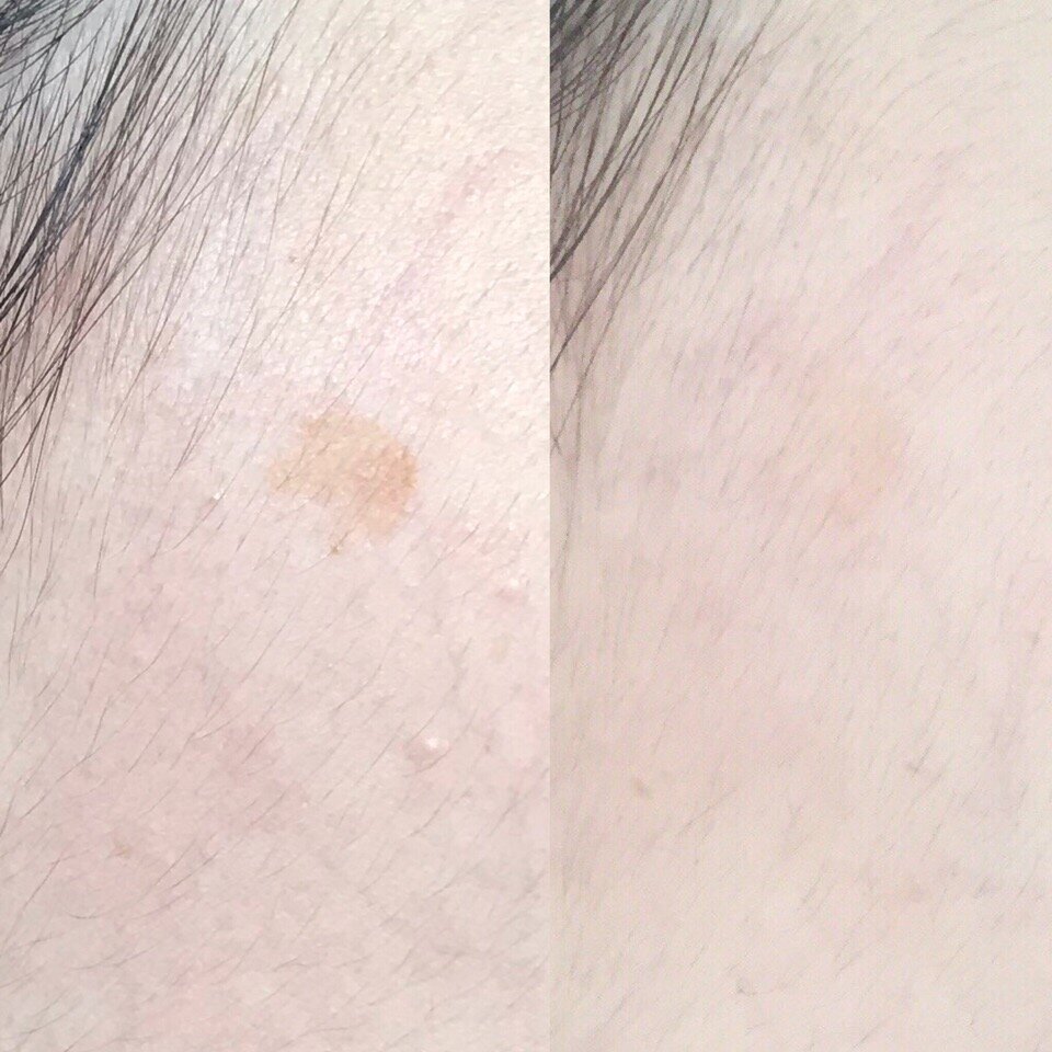 Личное фото. Бадяга от пигментных пятен. До, после