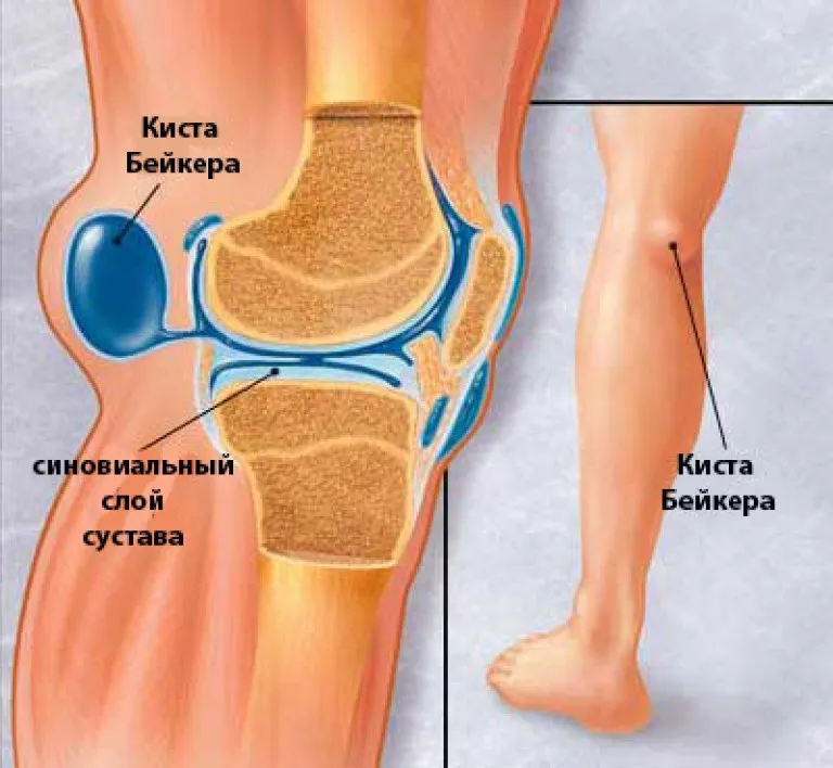 Что такое киста беккера