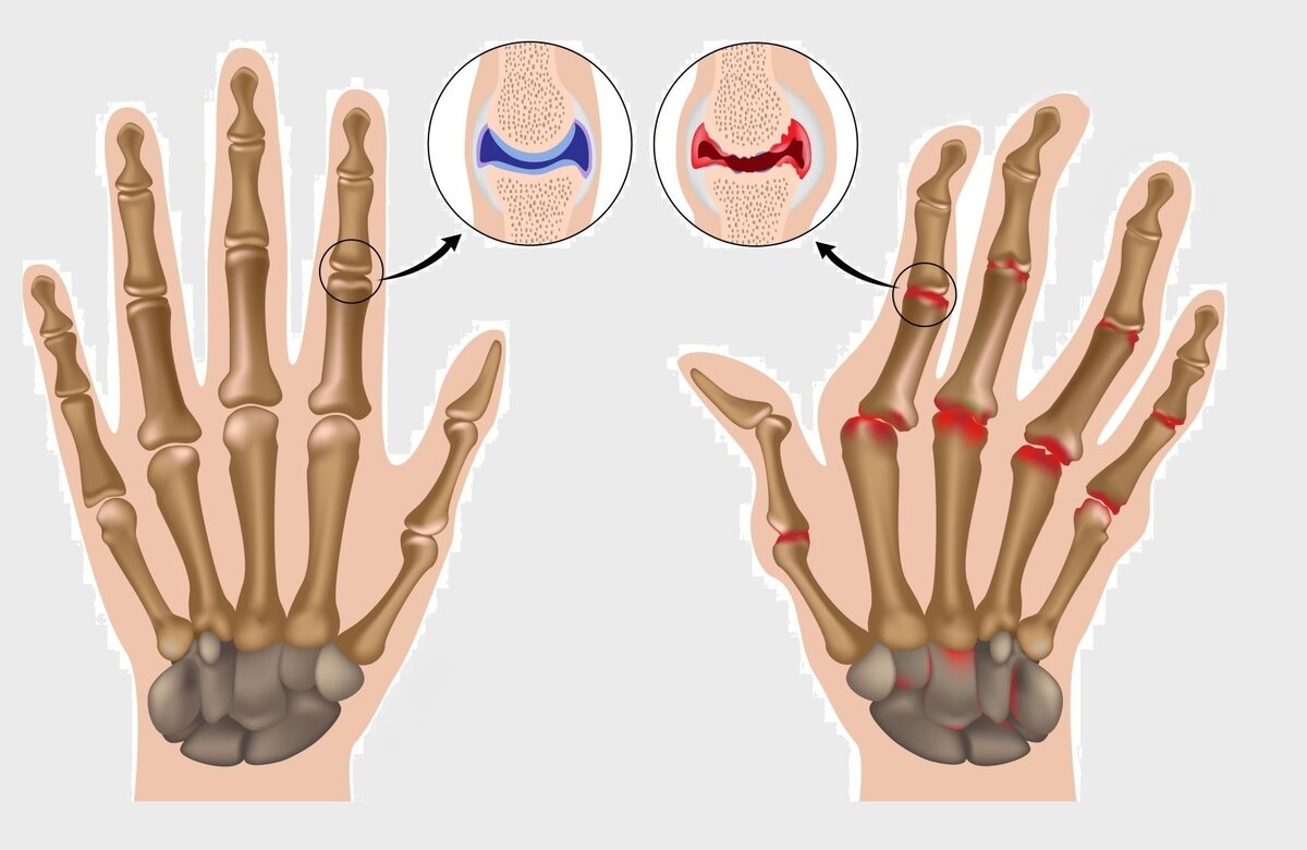 Как артрит вызывает боль в суставах