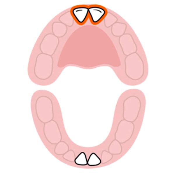 Верхние центральные резцы