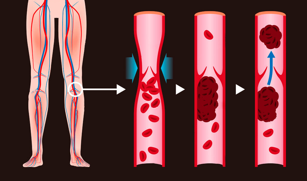 Тромбоз артерия и вена. Тромбоз закупорка сосудов. Тромбоз и эмболия и атеросклероз.