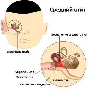 Что делать, если стреляет в ухе?