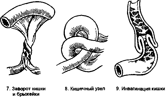 Симптомы заворота кишок