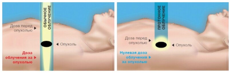 Чтобы минимизировать повреждения здоровых тканей необходимо, чтобы доза была сосредоточена в области опухоли.