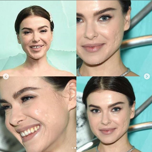 Знаменитая певица, экс-участница группы Серебро Елена Темникова рассказала, что в ближайшее время признается, какие проблемы с лицом преследуют ее на протяжении всей жизни.