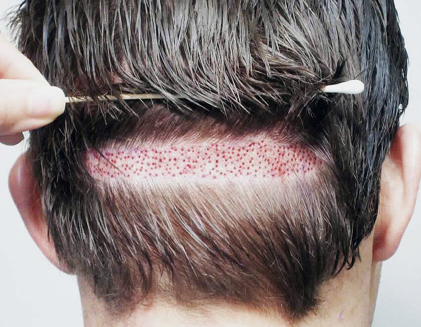 Shaving Line - Метод изъятия волос при пересадке