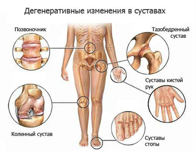 Ревматоидный артрит ног: лечение и симптомы - статьи от компании Еламед