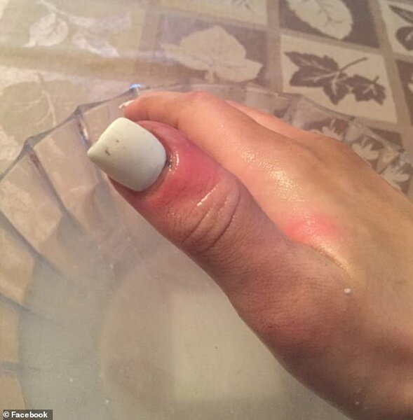 Палец Каролины покраснел и опух