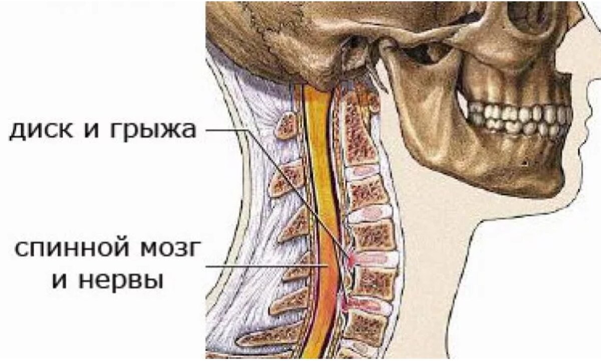 Как вылечить грыжу шейного отдела