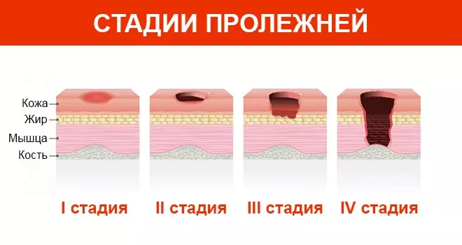 Начальная стадия пролежней. Обработка пролежней 3 стадии. Отслойка эпидермиса пролежни. Стадии развития пролежней (1 правильный ответ):. 3 Стадия развития пролежней.