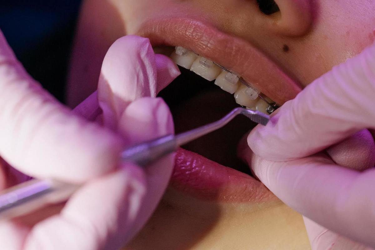 Стирание зубов ортодонтия