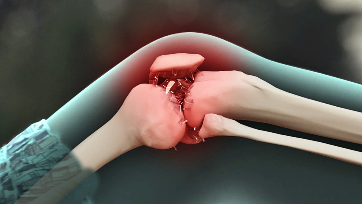 на картинке остеоартроз коленного сустава