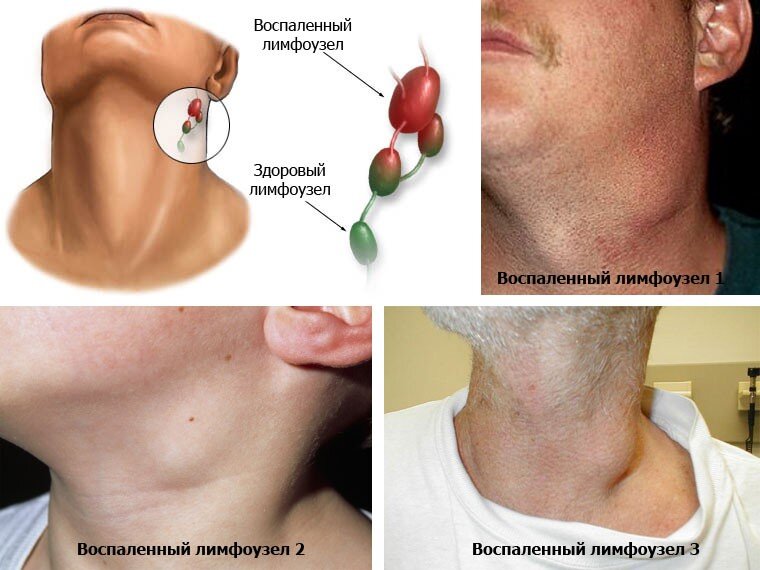 Воспаление лимфоузлов на шее: лечение, симптомы и причины шейного лимфаденита