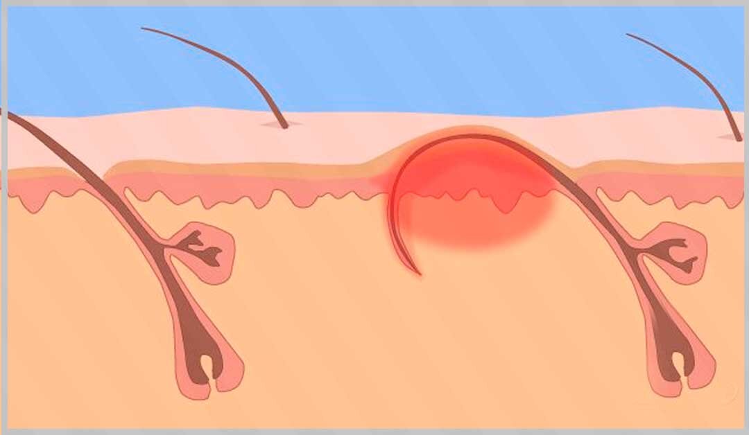 Припухлость покрывает растущий волос, который упирается изнутри и усиливает раздражение.