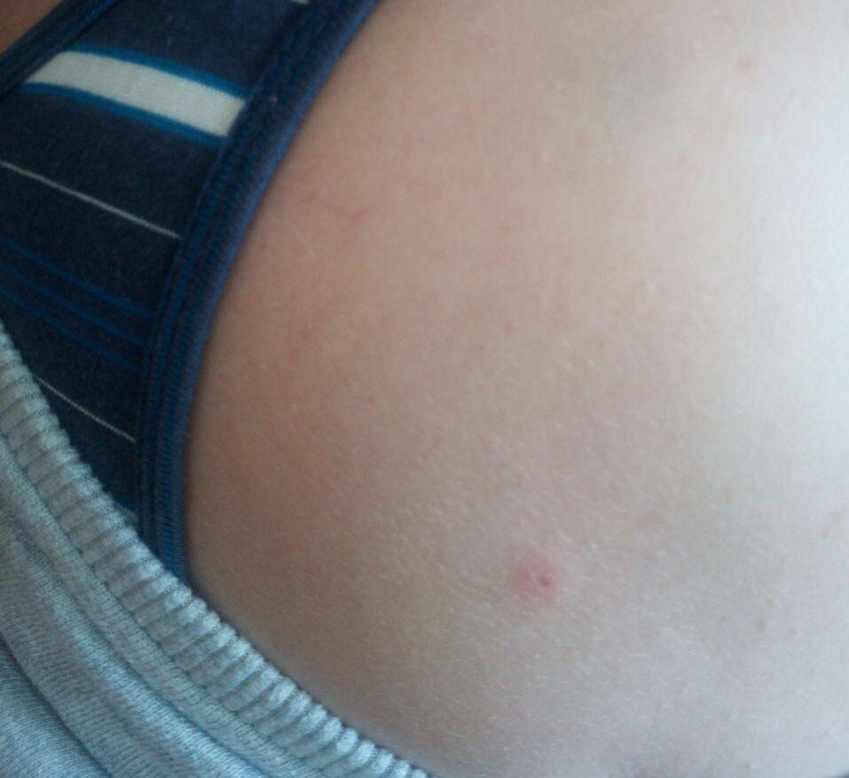 Так выглядит укус клеща  в первые 24 часа.  В последствие может развиться эритема вокруг (красное пятно, напоминающее кольца с переходом цвета. Эритема - признак боррелиоза. Фото прислали пострадавшие). Боррелиоза у ребенка пока не обнаружено, признаков никаких нет. С момента укуса прошел почти месяц (следа уже не осталось)