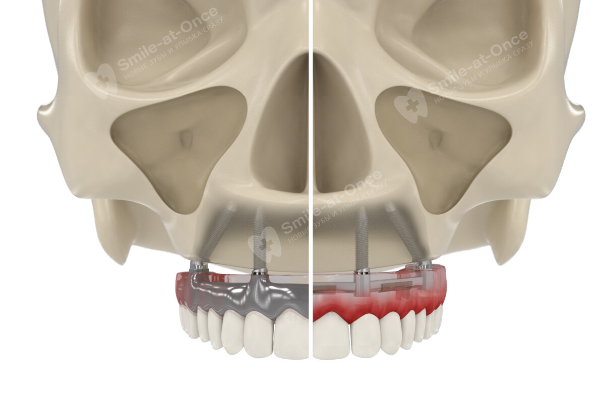 Импланты верхняя челюсть отзывы. Имплантация верхней челюсти на 6 имплантах.