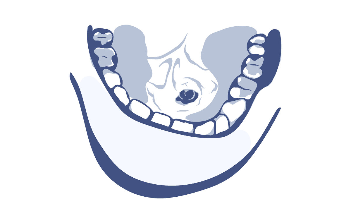 Камень в протоке подчелюстной железы 