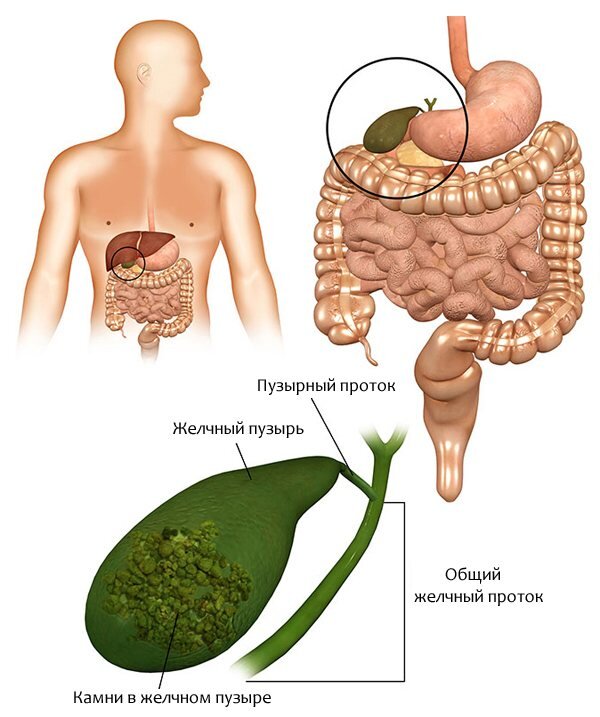 Как бороться с густой желчью в желчном пузыре
