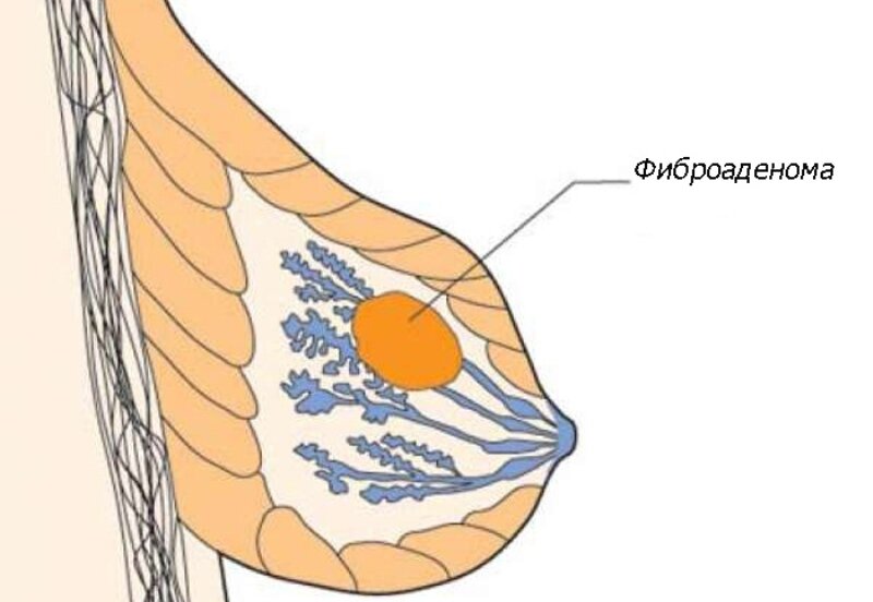 Фиброаденома это