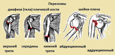  Некоторые виды полных сломов тела и хирургической шейки