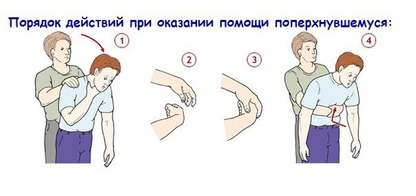 Схема приема Геймлиха