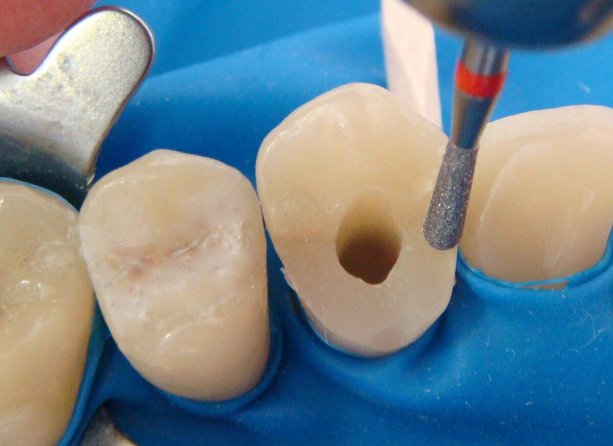 Чистка каналов зуба и временная пломба