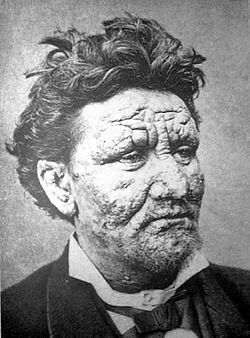 Лицо 24-летнего больного лепрой. 1886 год. Источник - ru.wikipedia.org 