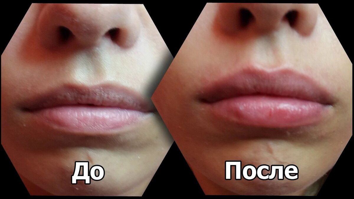 Губы после увеличения по дням заживления. Увеличение губ филлером до и после 1 мл. Губы гиалуроновой кислотой до и после.