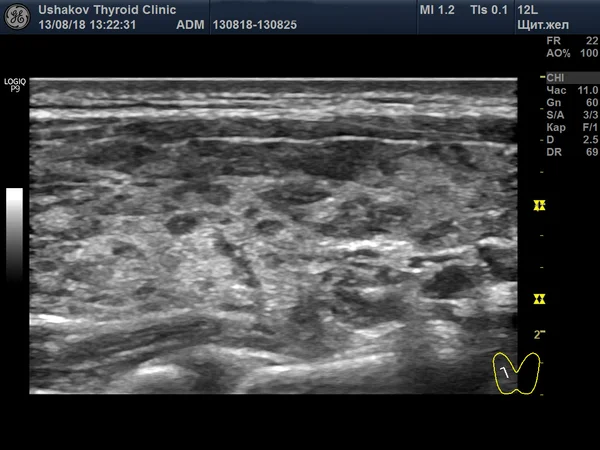 УЗИ щитовидной железы при АИТ