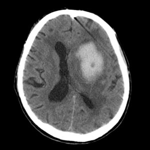  КТ при геморрагическом инсульте  