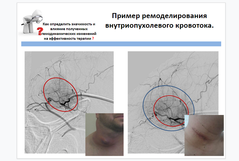 Пример ремоделирования внутриопухолевого кровотока у пациента с лимфомой