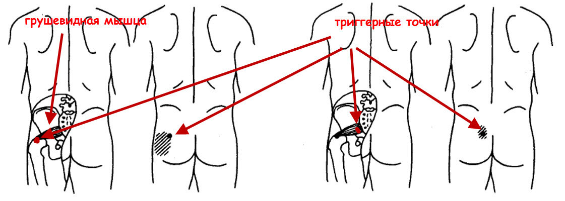 Отдает в заднем проходе что это. Триггерные точки грушевидной мышцы. Синдром грушевидной мышцы триггерные точки. Триггерные точки для расслабления грушевидная мышца. Триггерные точки седалищного нерва.