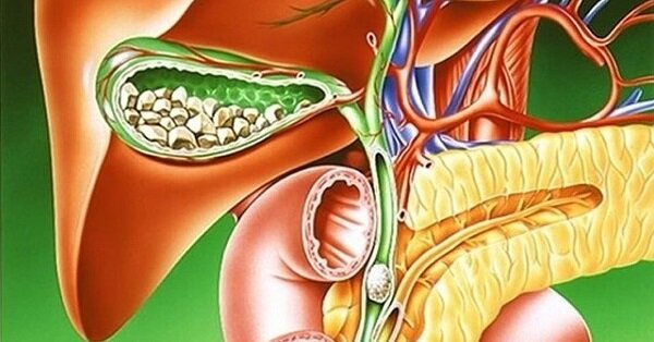 Желчнокаменная болезнь - что это, причины, симптомы, диета и лечение