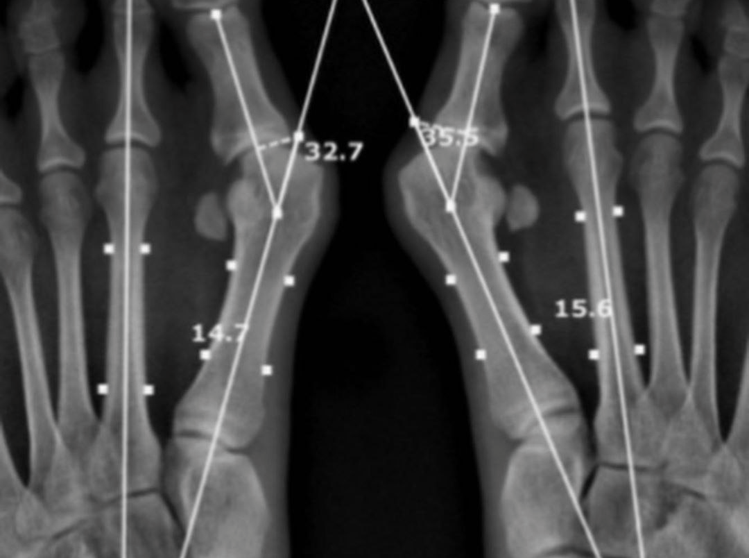 Углы стопы. Артродез Лапидус Lapidus-Arthrodesis. Артродез 1 плюснеклиновидного сустава.