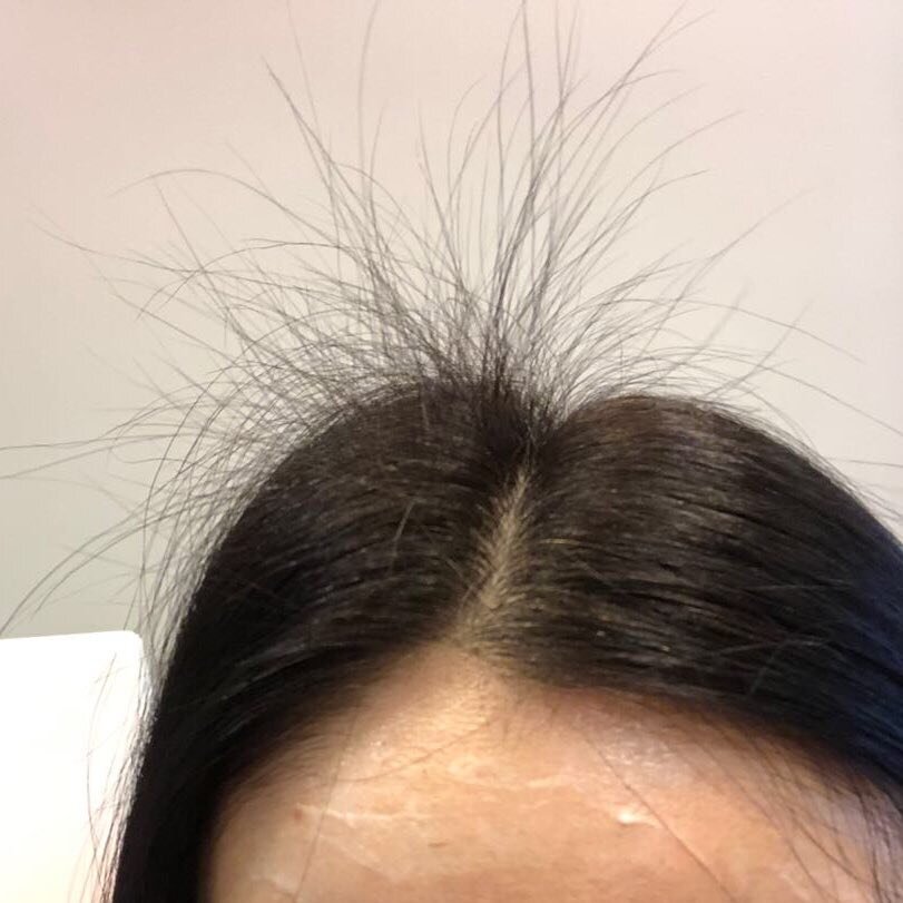 Результат правильного трихологического лечения