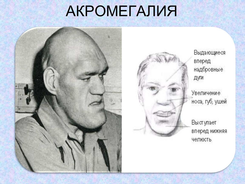 Синдром 30 лет. Акромегалия акромегалия. Соматотропный гормон акромегалия. Акромегалия при аденоме гипофиза. Акромегалия надбровные дуги.