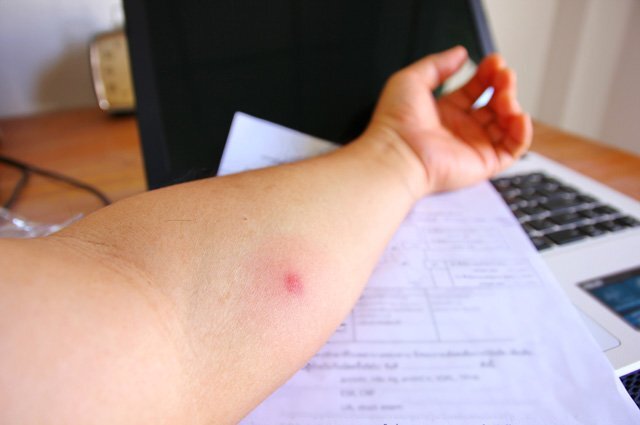    В чем разница между реакцией Манту и диаскинтестом?