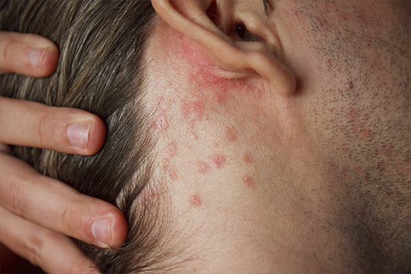 Аллергия на лице - лечение аллергической сыпи у взрослых: виды и чем лечить