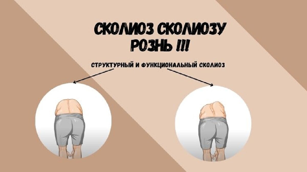 Сколиоз сколиозу рознь! Структурный и функциональный сколиоз | Сколио центр  | Дзен