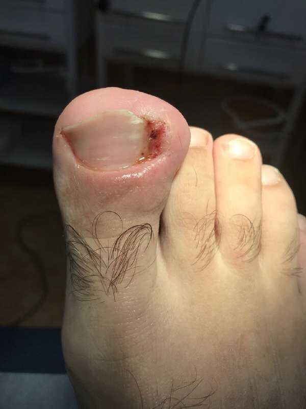 Большинство из нас сталкивались с данным заболеванием если ни у себя, то точно видели у кого либо. 