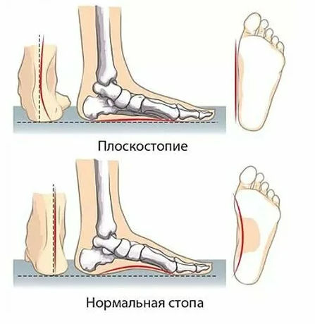 На рисунке вверху (плоская стопа) видно нарушение на костном уровне, когда ладьевидная кость опущена, и стопа ВСЕГДА остается плоской, даже в состоянии разгрузки, - лежа. Это и есть истинное плоскостопие.