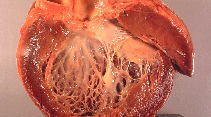     Сердце с кардиомиопатией Wikimedia Commons / CDC, Dr. Edwin P. Ewing, Jr.