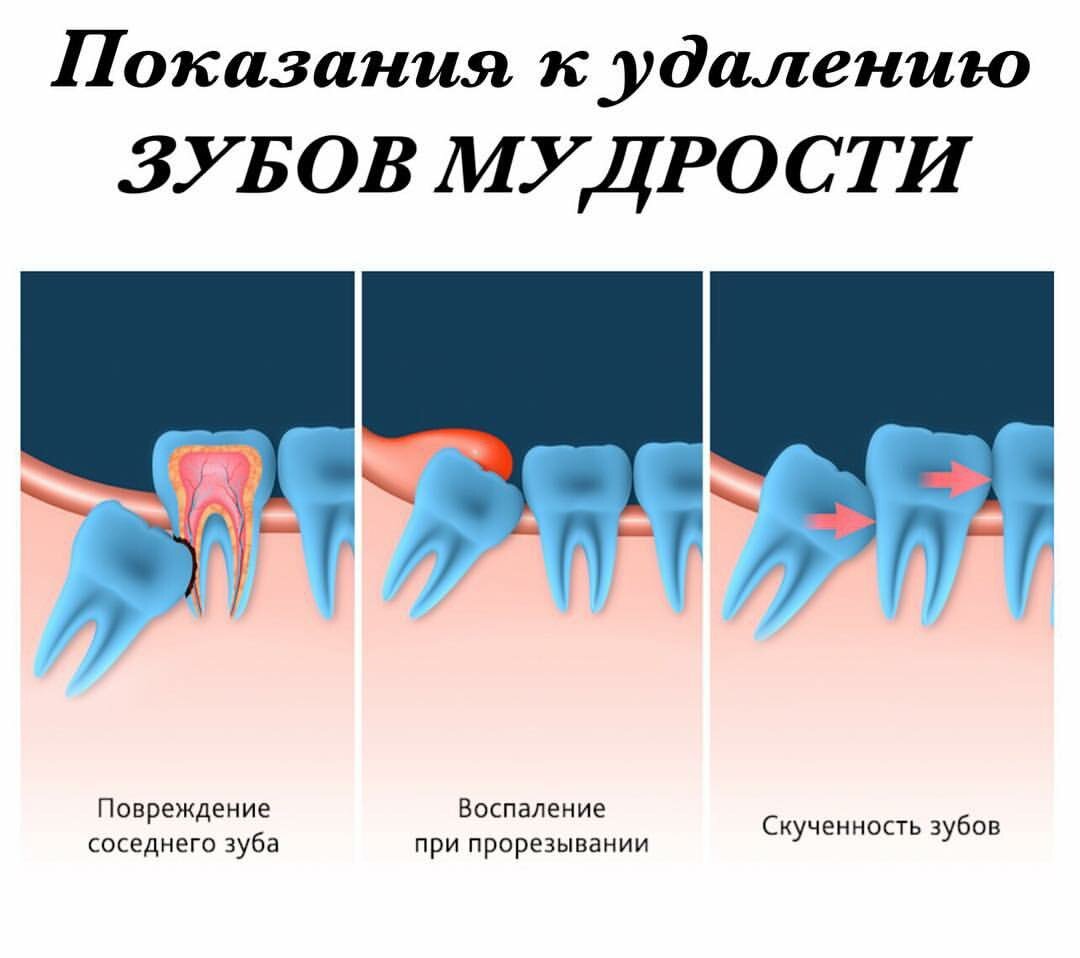 Рекомендации после удаления зуба мудрости | Стоматология на Волгина | Дзен