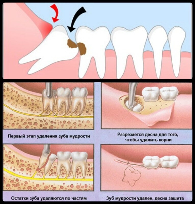 В каких случаях удаляют зуб. Удалили 8 зуб снизу мудрости. Как удаляют зуб мудрости.