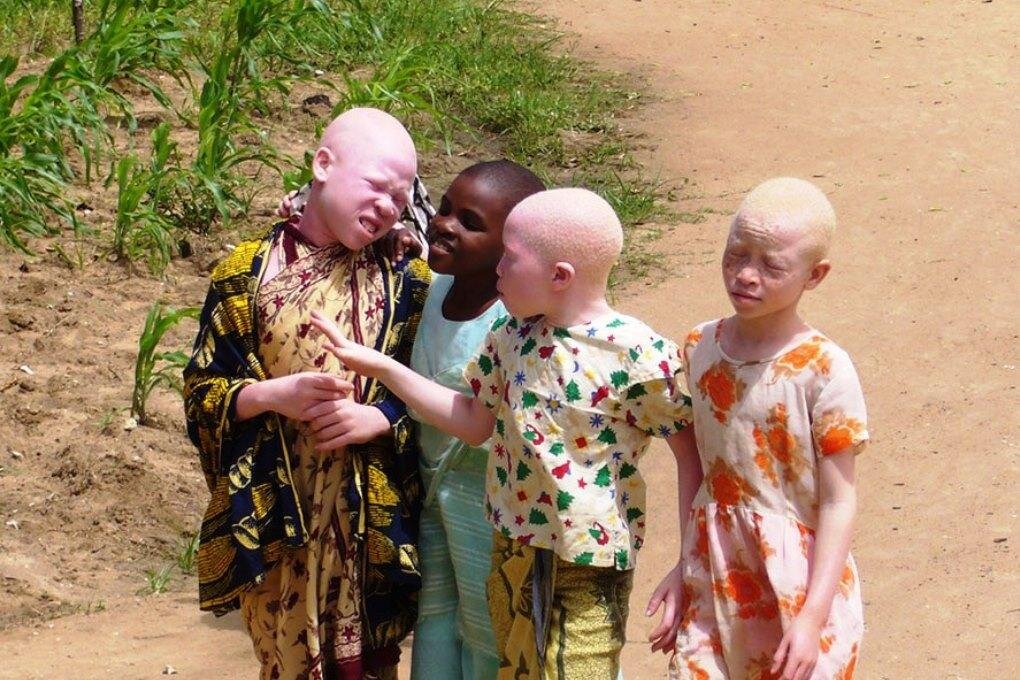 Племя близнецов. Мир наизнанку Танзания альбиносы. Африканские дети альбиносы.