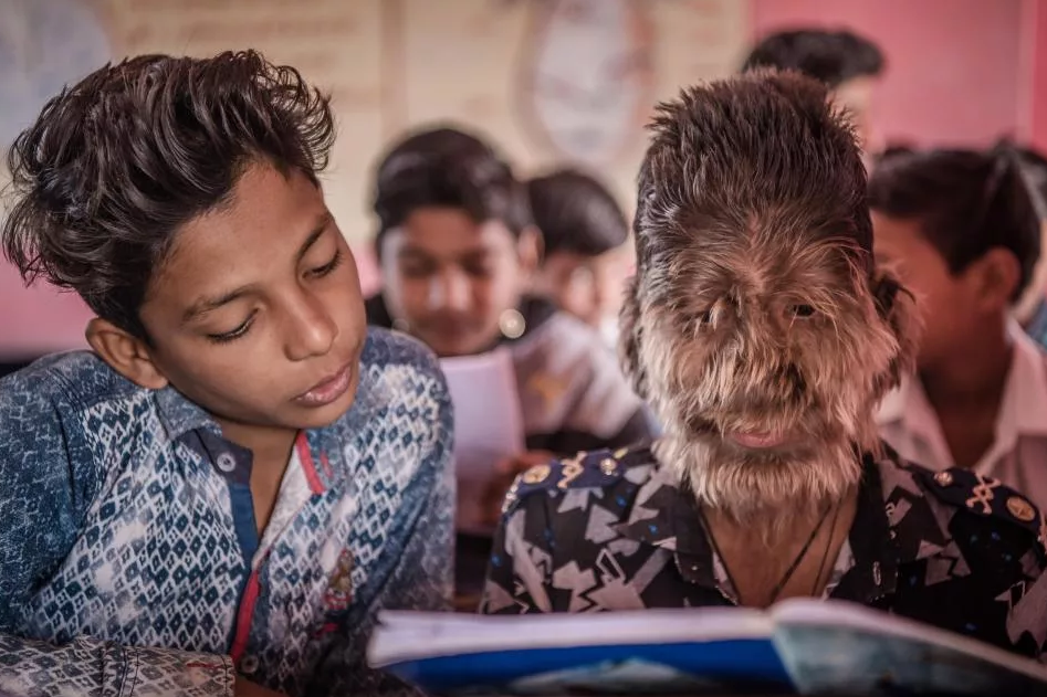 болезнь бенджамина баттона. как называют людей с отклонениями. девочка с синдромом бенджамина баттона. синдром халлермана штрайфа мишель. микроцефалы зипа и пипа.